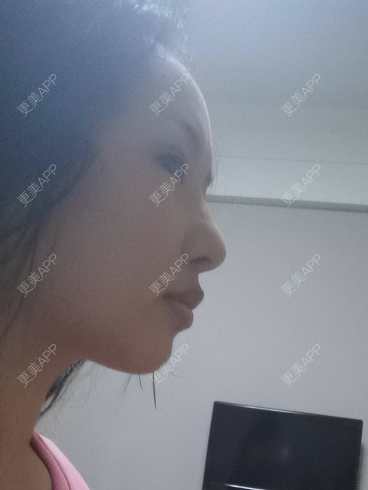 更美 - 沉沉mm的吸脂瘦脸经验 | 轮廓修复术 | 全脸整形套餐 | V脸套餐 | 激光溶脂瘦脸 | 射频溶脂瘦脸 | 吸脂瘦脸 | 自体脂肪丰面颊 | 吸脂 | 背部吸脂 | 手臂吸脂 | 玻尿酸面颊 | 胶原蛋白丰面颊 | 面部不对称矫正
