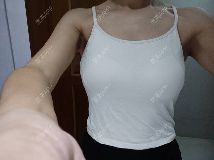 更美 - 更美用户gzfn64zuwo的丰胸(隆胸)日记 | 自体脂肪隆胸 | 乳房
