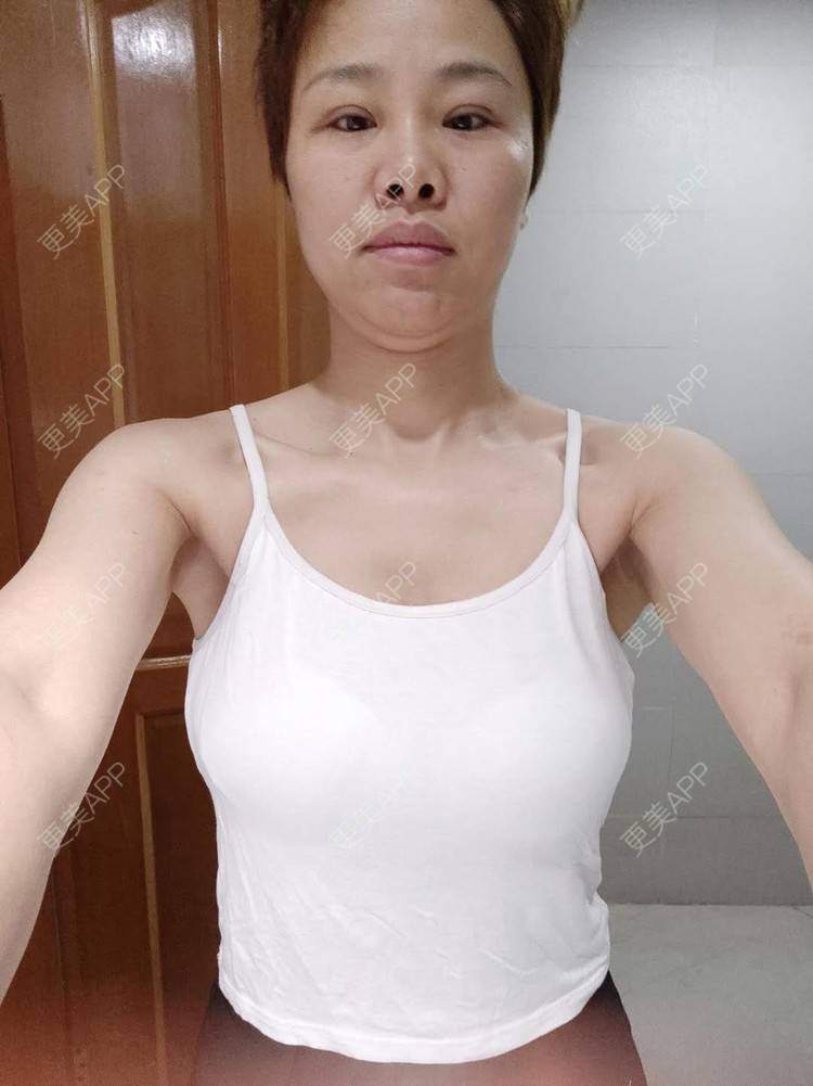 自体脂肪隆胸 | 乳房再造 | 胸部下垂矫正 | 美胸套餐 | 复合 