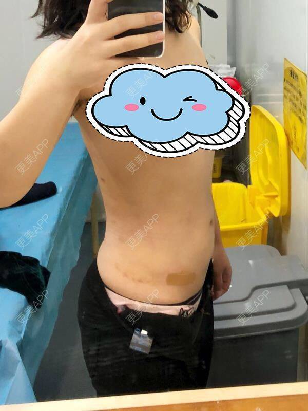更美 - 更美用户DIxL1CLEQF的手臂吸脂经验 | 射频溶脂瘦手臂 | 射频溶脂瘦腹部 | 深圳 | 腰部吸脂
