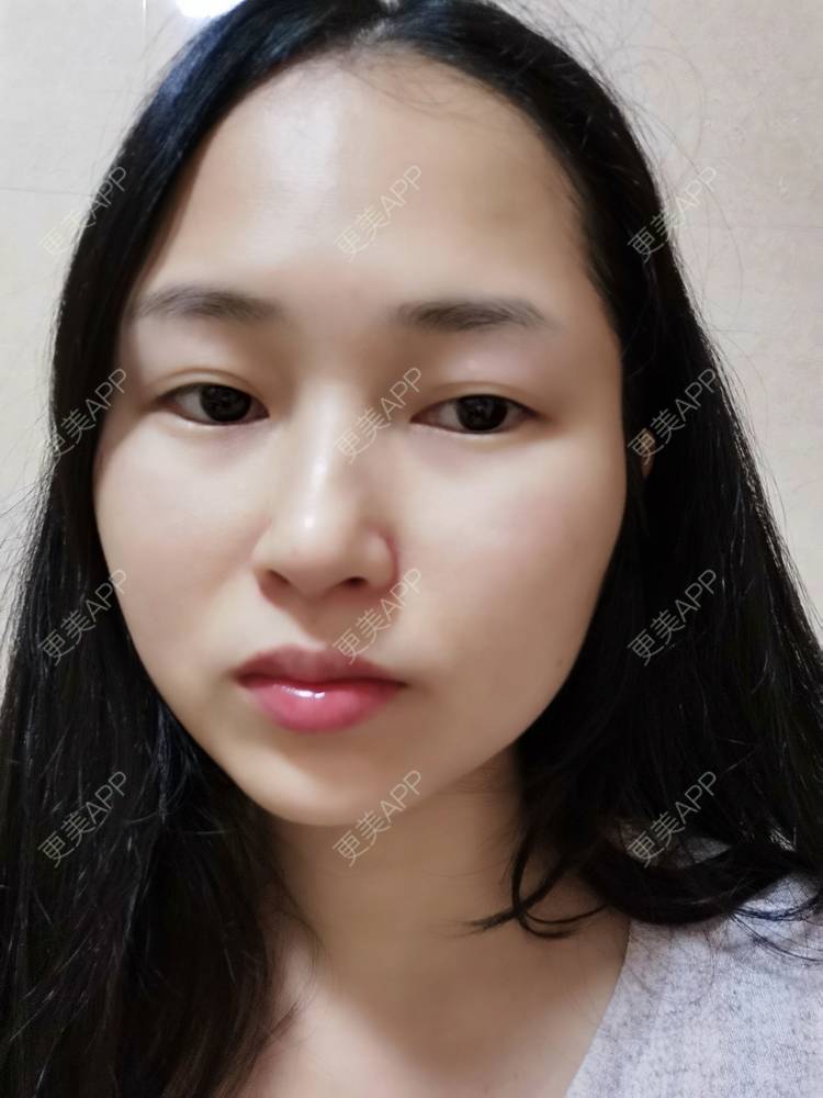 更美 - 小桃桃源的清洁水光补水经验 | 清洁水光补水 | 广州 | 皮肤综合管理套餐