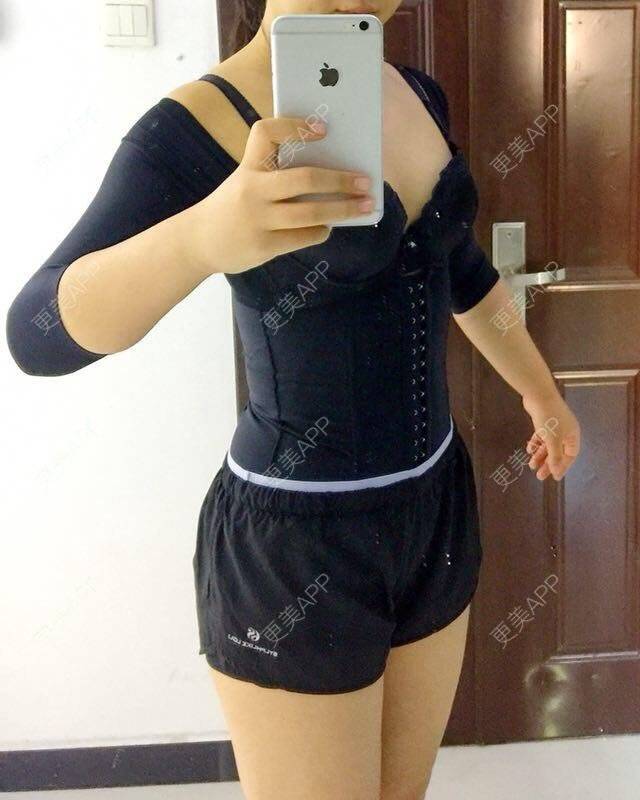 更美 - 更美用户DIxL1CLEQF的手臂吸脂经验 | 手臂吸脂 | 腹部吸脂 | 深圳 | 射频溶脂瘦手臂 | 射频溶脂瘦腹部 | 腰部吸脂