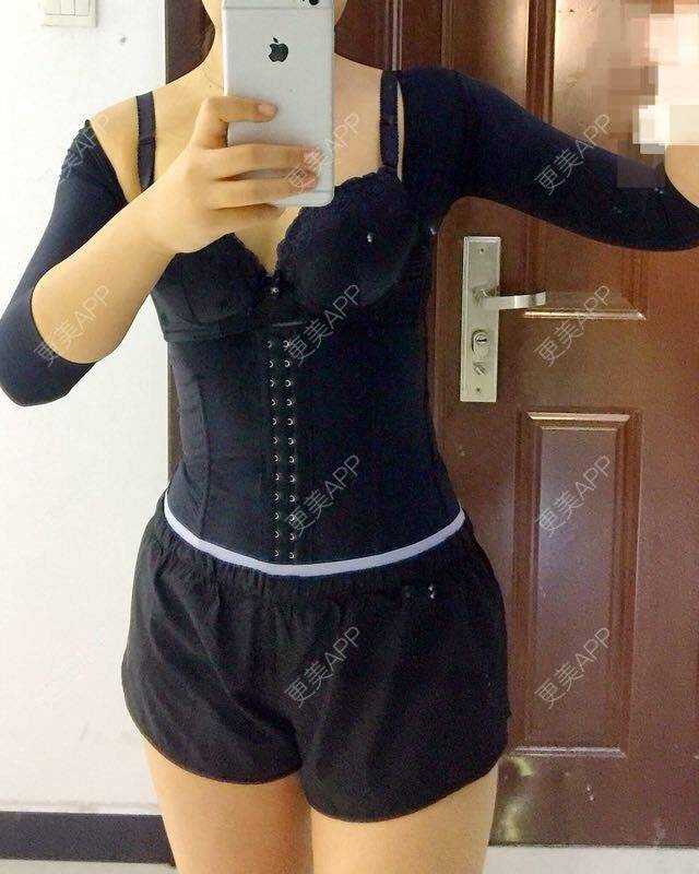 更美 - 更美用户DIxL1CLEQF的手臂吸脂经验 | 手臂吸脂 | 腹部吸脂 | 深圳 | 射频溶脂瘦手臂 | 射频溶脂瘦腹部 | 腰部吸脂
