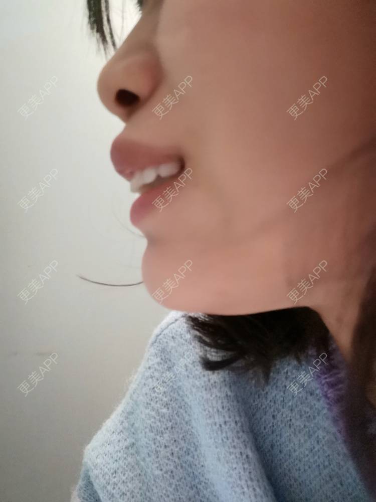 更美 - 更美用户YWdQyE2kiR的金属托槽矫正经验 | 北京 | 金属托槽矫正