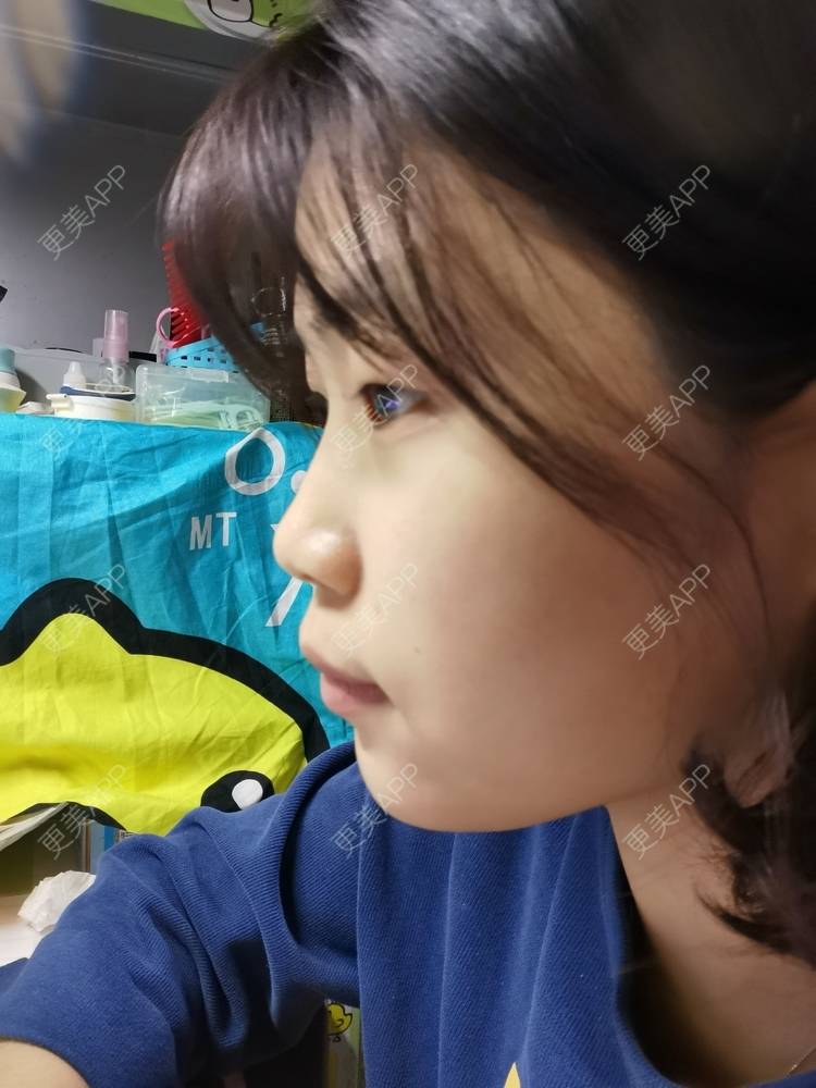 更美 - 更美用户YWdQyE2kiR的金属托槽矫正经验 | 北京 | 金属托槽矫正