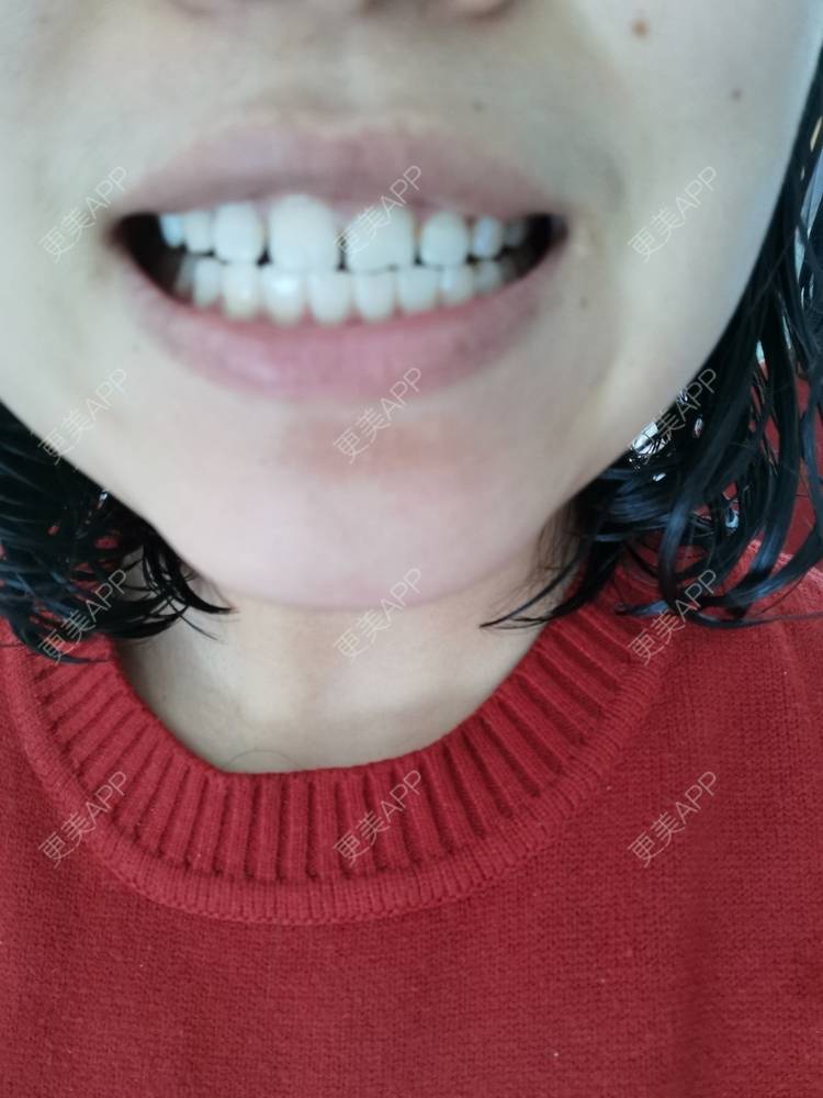 更美 - 更美用户YWdQyE2kiR的金属托槽矫正经验 | 北京 | 金属托槽矫正