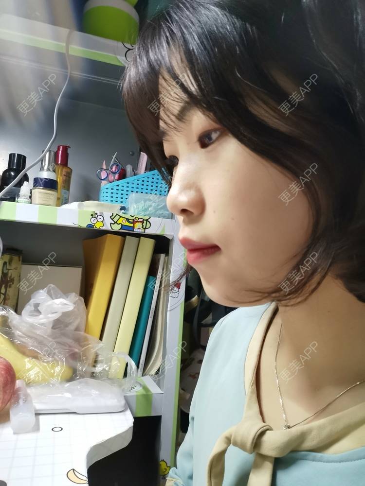 更美 - 更美用户YWdQyE2kiR的金属托槽矫正经验 | 北京 | 金属托槽矫正