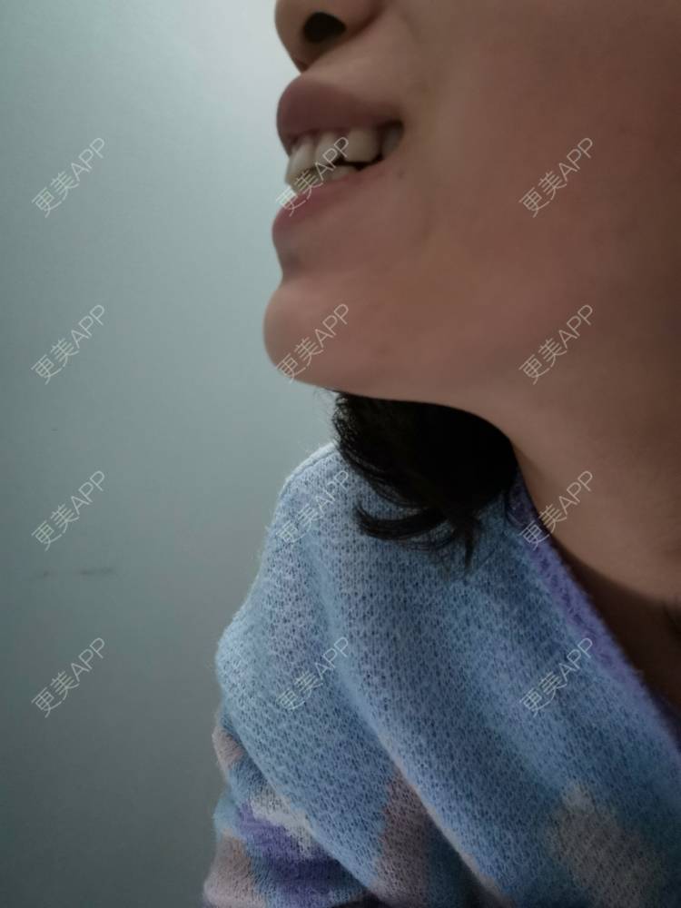 更美 - 更美用户YWdQyE2kiR的金属托槽矫正经验 | 北京 | 金属托槽矫正