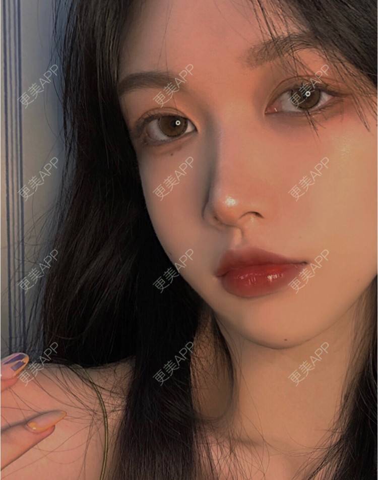 更美 - 奶皮欧尼的玻尿酸下巴经验 | 玻尿酸下巴 | 南京