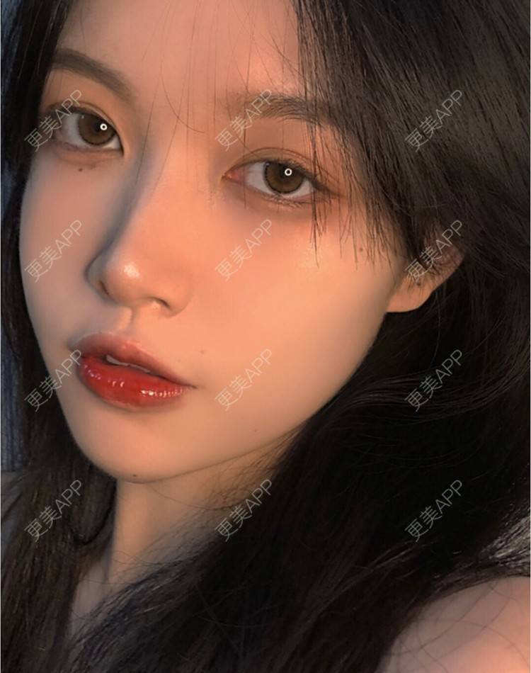 更美 - 奶皮欧尼的玻尿酸下巴经验 | 玻尿酸下巴 | 南京