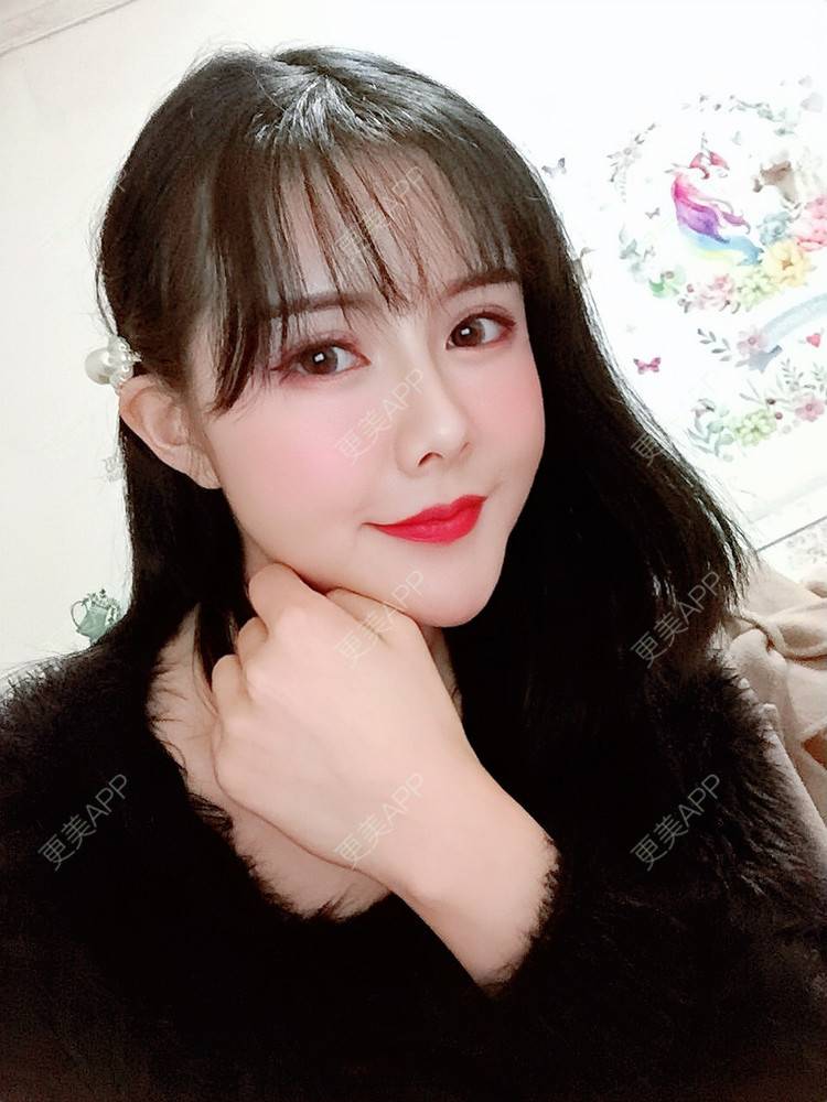 更美 - Daisy11的自体脂肪全面部填充经验 | 自体脂肪全面部填充 | 视频日记 | 重庆