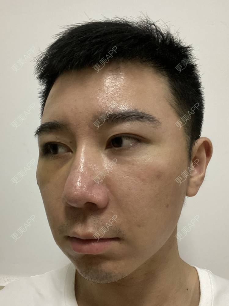 更美 - Es小喵的埋线提升经验 | V脸套餐 | 广州 | 埋线提升 | 埋线除皱