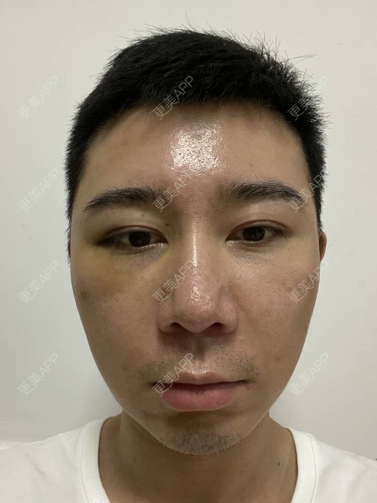 更美 - Es小喵的埋线提升经验 | V脸套餐 | 广州 | 埋线提升 | 埋线除皱