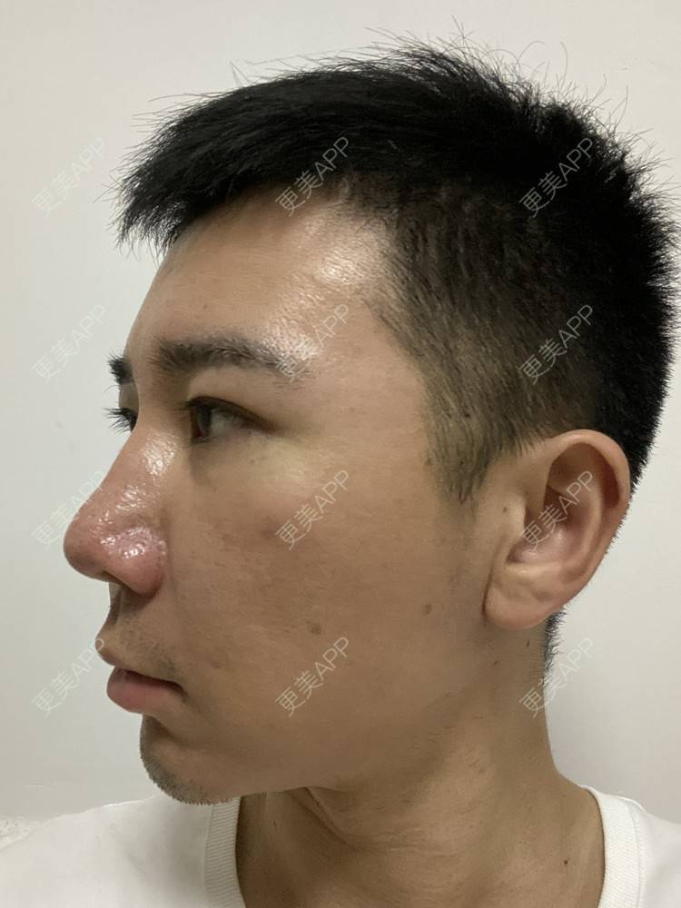 更美 - Es小喵的埋线提升经验 | V脸套餐 | 广州 | 埋线提升 | 埋线除皱