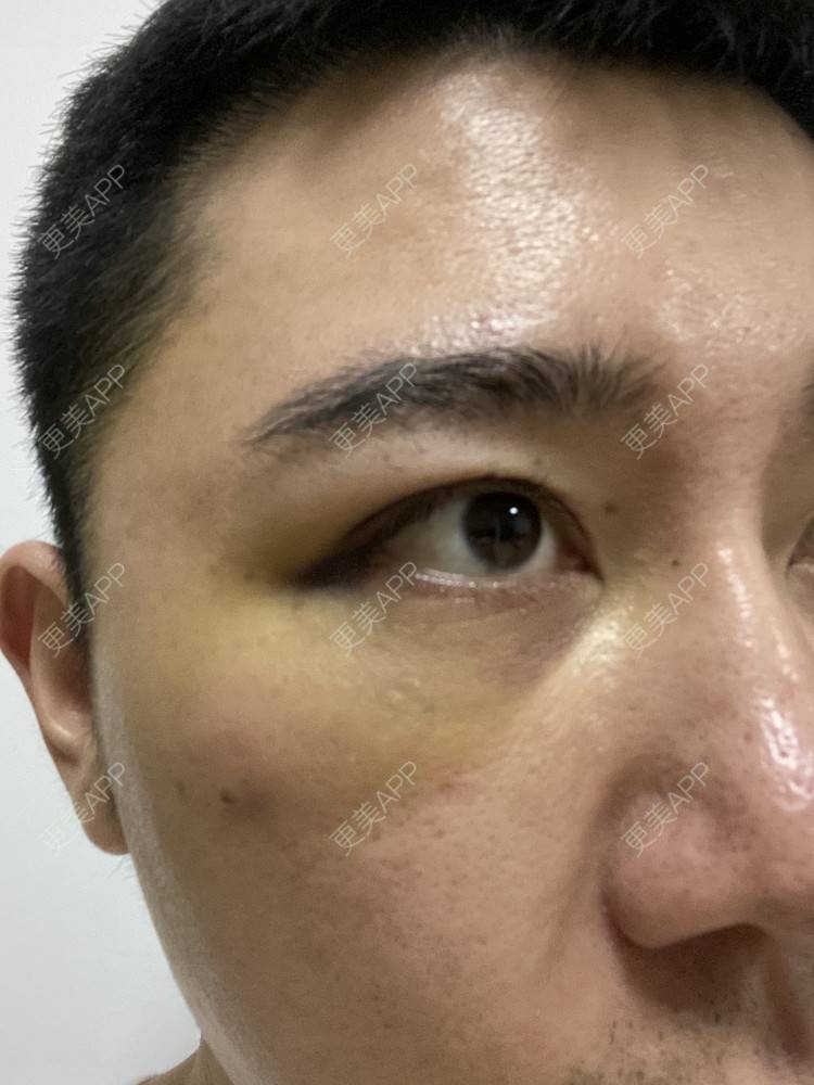 更美 - Es小喵的埋线提升经验 | V脸套餐 | 广州 | 埋线提升 | 埋线除皱