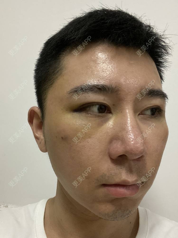 更美 - Es小喵的埋线提升经验 | V脸套餐 | 广州 | 埋线提升 | 埋线除皱