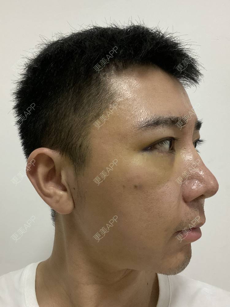 更美 - Es小喵的埋线提升经验 | V脸套餐 | 广州 | 埋线提升 | 埋线除皱