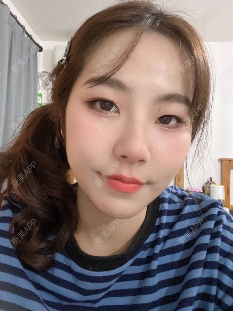 更美 - 更美用户LlGf9K7w9y的眼部多项经验 | 青岛 | 眼部多项