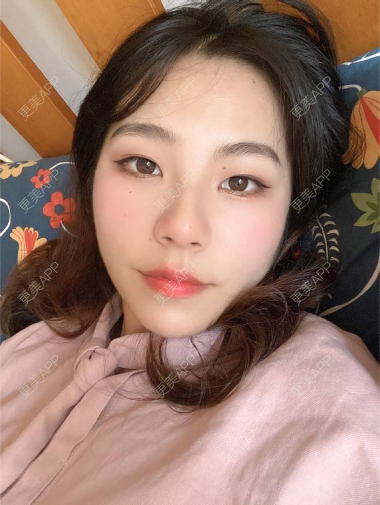 更美 - 更美用户LlGf9K7w9y的眼部多项经验 | 青岛 | 眼部多项
