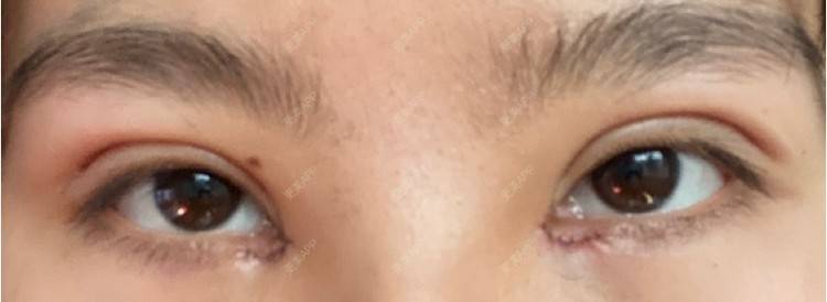 更美 - 更美用户LlGf9K7w9y的眼部多项经验 | 青岛 | 眼部多项