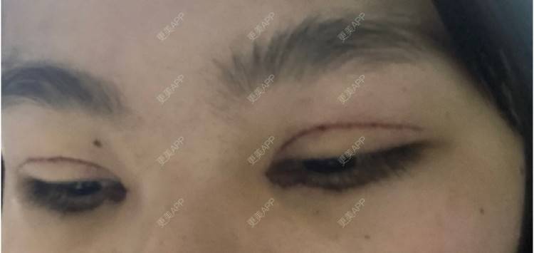 更美 - 更美用户LlGf9K7w9y的眼部多项经验 | 青岛 | 眼部多项