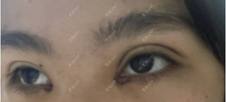 更美 - 更美用户LlGf9K7w9y的眼部多项经验 | 青岛 | 眼部多项
