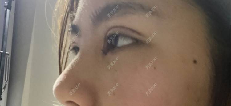 更美 - 更美用户LlGf9K7w9y的眼部多项经验 | 青岛 | 眼部多项
