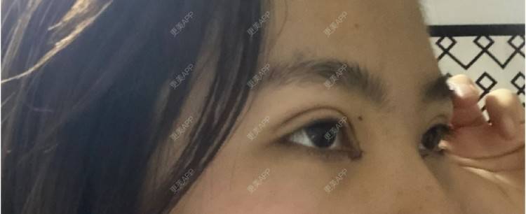 更美 - 更美用户LlGf9K7w9y的眼部多项经验 | 青岛 | 眼部多项