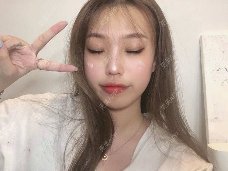 更美 - 二闪亮晶晶的全切双眼皮经验 | 广州 | 全切双眼皮