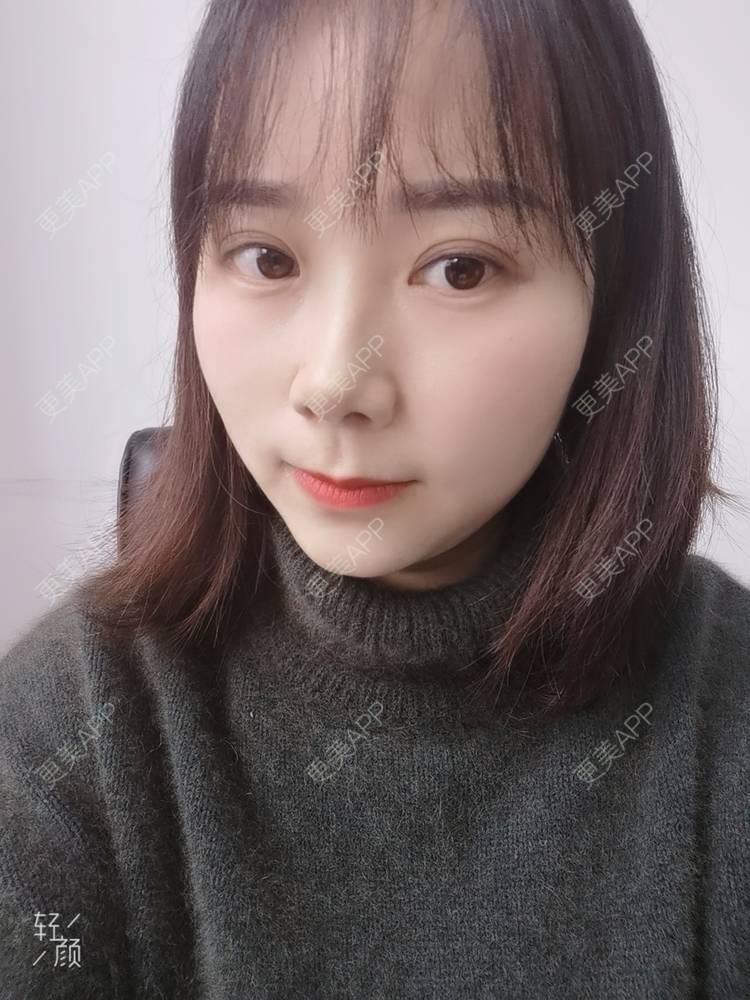 更美 - 更美用户2xnQj47lDg的眼部综合经验 | 眼部综合 | 重庆