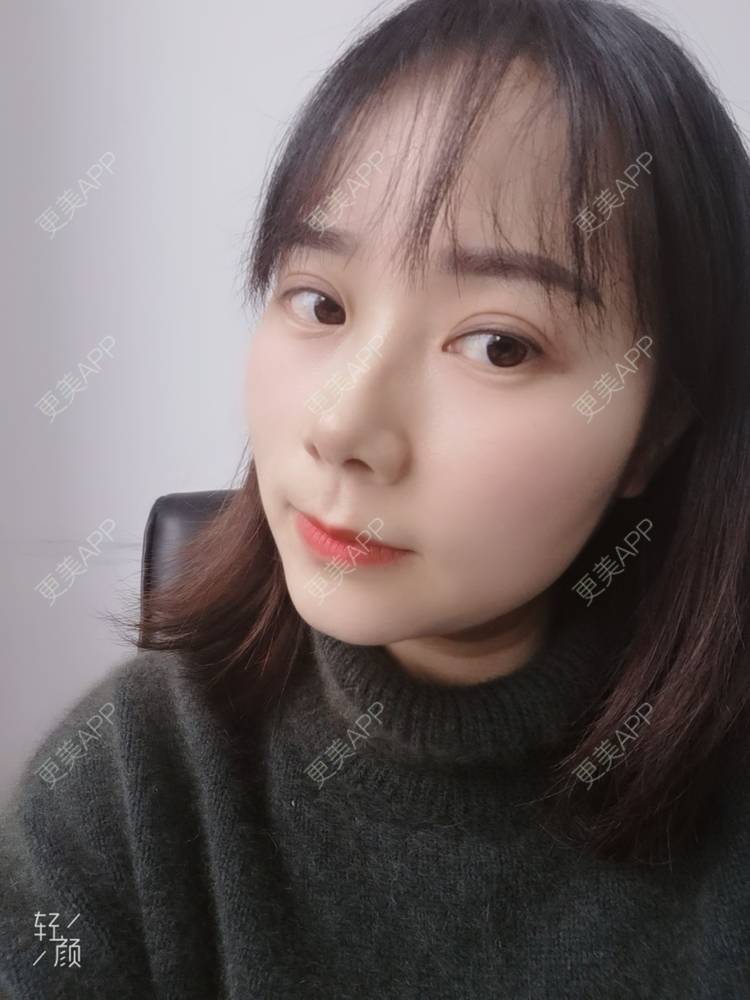 更美 - 更美用户2xnQj47lDg的眼部综合经验 | 眼部综合 | 重庆