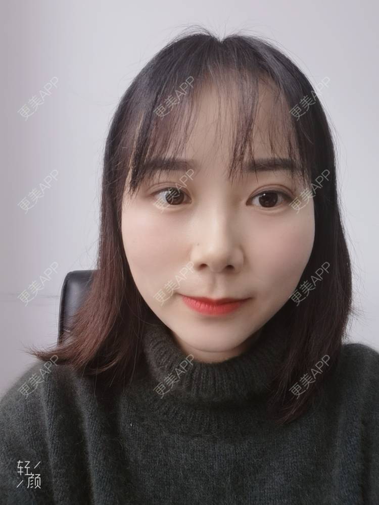 更美 - 更美用户2xnQj47lDg的眼部综合经验 | 眼部综合 | 重庆