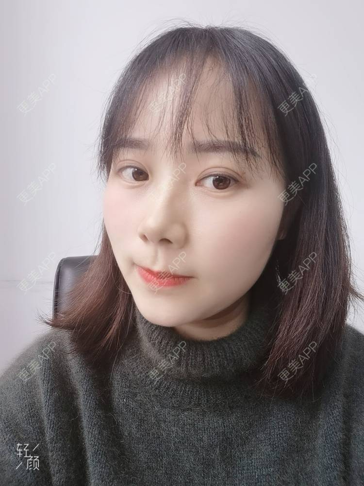 更美 - 更美用户2xnQj47lDg的眼部综合经验 | 眼部综合 | 重庆