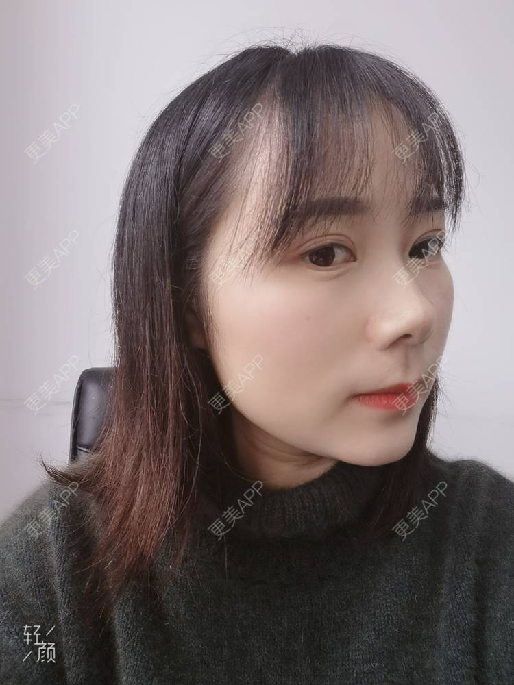 更美 - 更美用户2xnQj47lDg的眼部综合经验 | 眼部综合 | 重庆