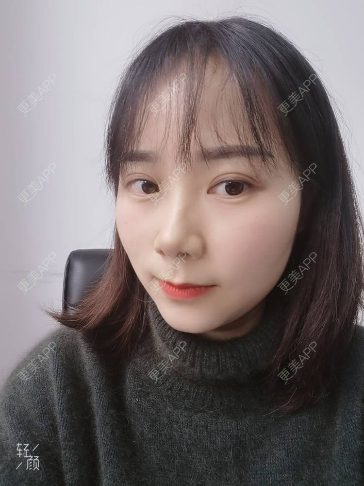 更美 - 更美用户2xnQj47lDg的眼部综合经验 | 眼部综合 | 重庆