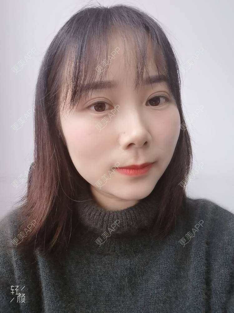 更美 - 更美用户2xnQj47lDg的眼部综合经验 | 眼部综合 | 重庆