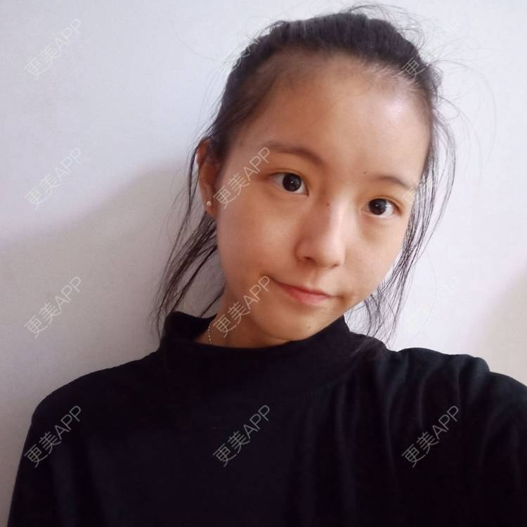 更美 - 苏州薇琳美容医院的双眼皮经验 | 双眼皮