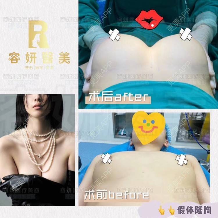 更美 - 上海容妍医疗美容门诊的隆胸手术修复经验 | 假体隆胸 | 复合隆胸 | 隆胸手术修复 | 美胸套餐 | 胸部下垂矫正