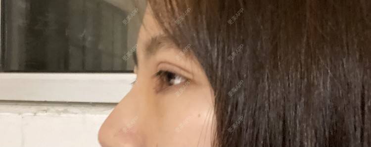 更美 - 更美用户LlGf9K7w9y的眼部多项经验 | 青岛 | 眼部多项