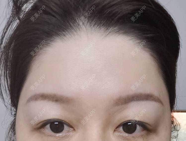 更美 - baoXbao的皮秒激光经验 | 皮秒激光 | 广州