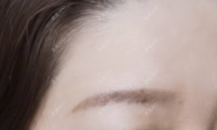 更美 - baoXbao的皮秒激光经验 | 皮秒激光 | 广州