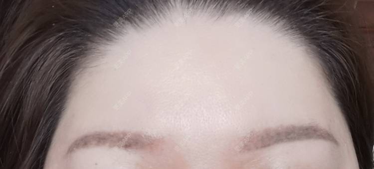 更美 - baoXbao的皮秒激光经验 | 皮秒激光 | 广州
