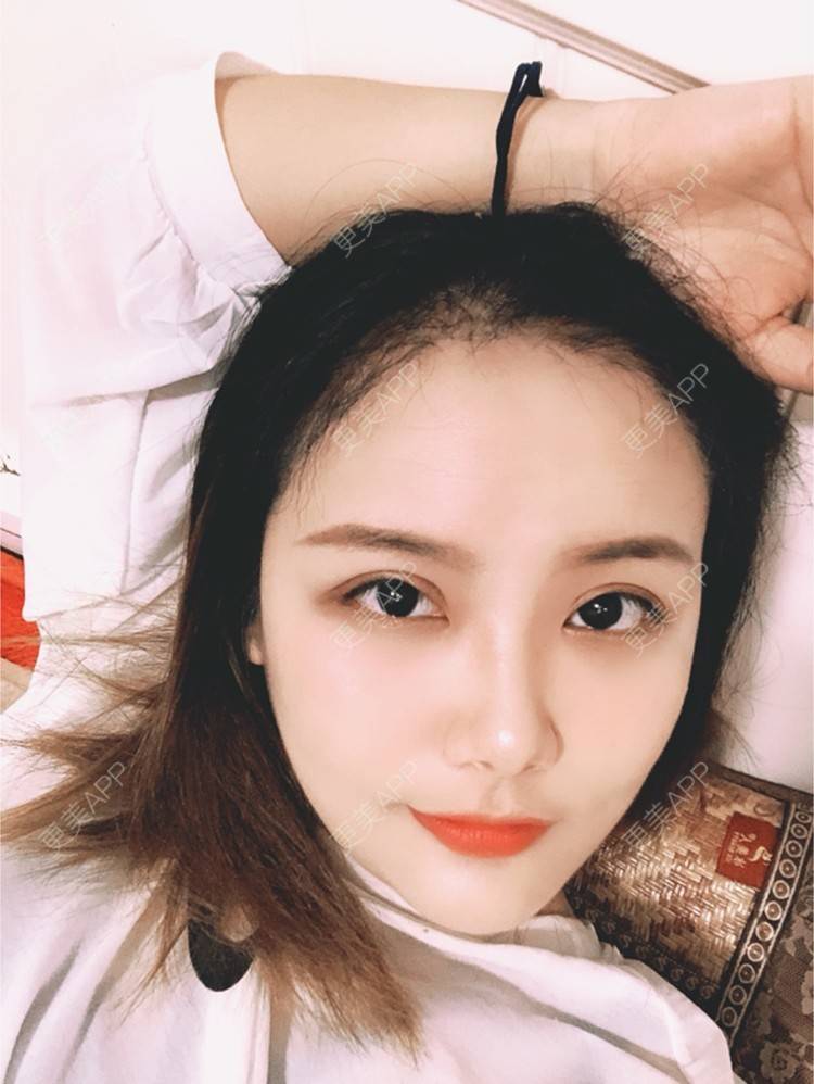 更美 - 奥多Ke。的植发际线经验 | 植发际线 | 南昌