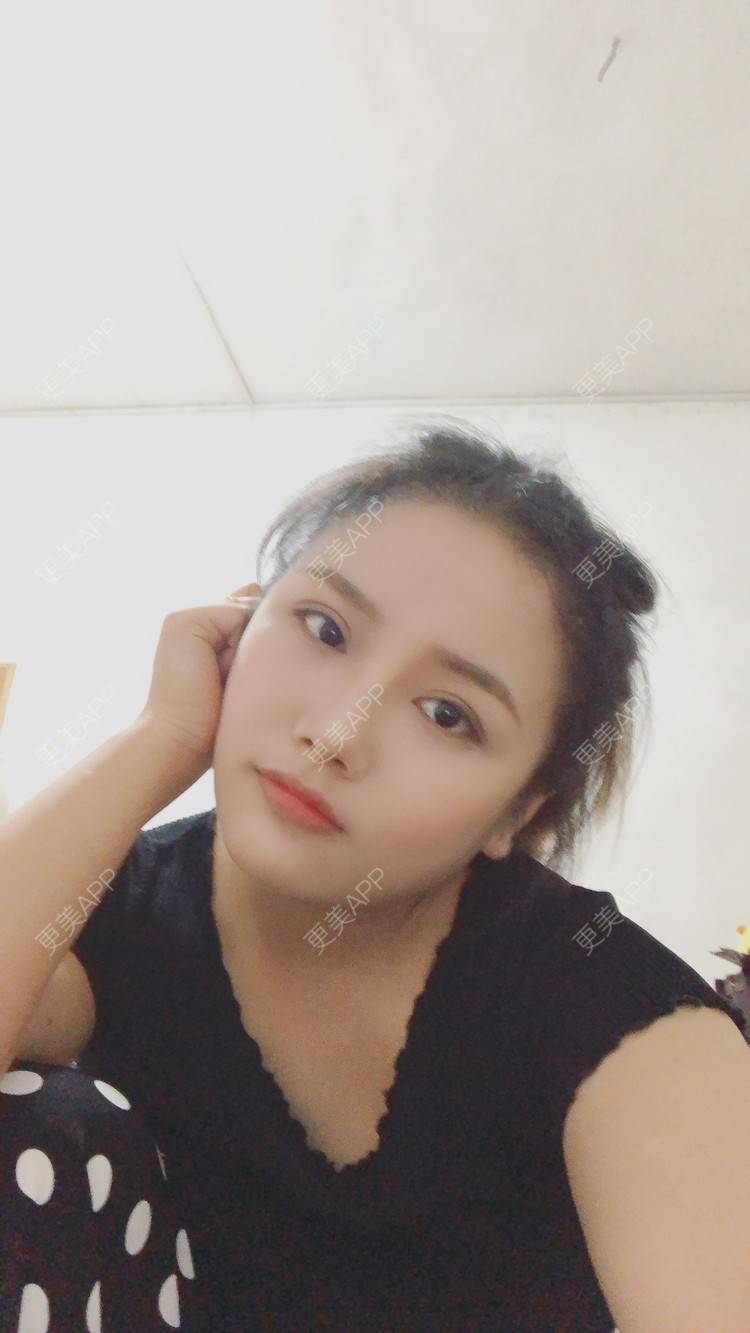 更美 - 奥多Ke。的植发际线经验 | 植发际线 | 南昌