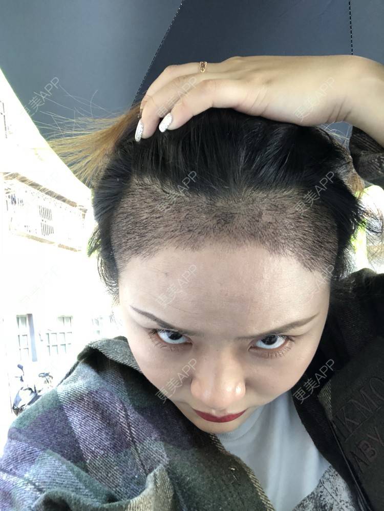 更美 - 奥多Ke。的植发际线经验 | 植发际线 | 南昌