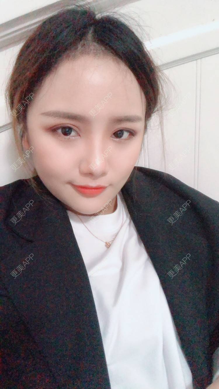 更美 - 奥多Ke。的植发际线经验 | 植发际线 | 南昌