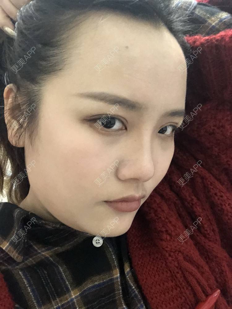 更美 - 奥多Ke。的植发际线经验 | 植发际线 | 南昌