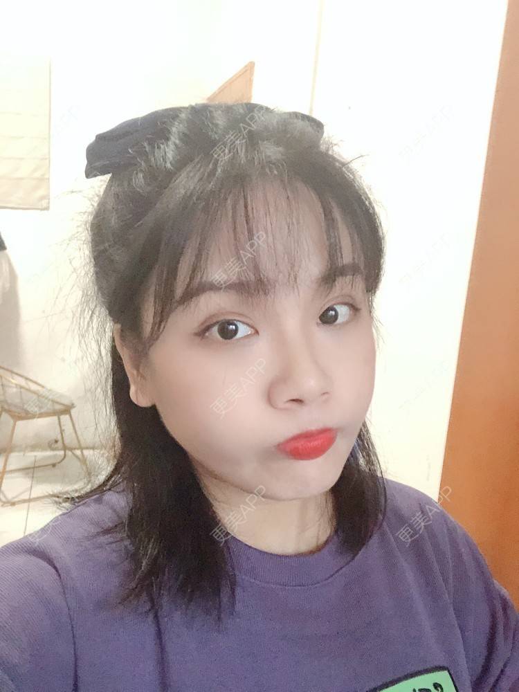 更美 - 奥多Ke。的植发际线经验 | 植发际线 | 南昌