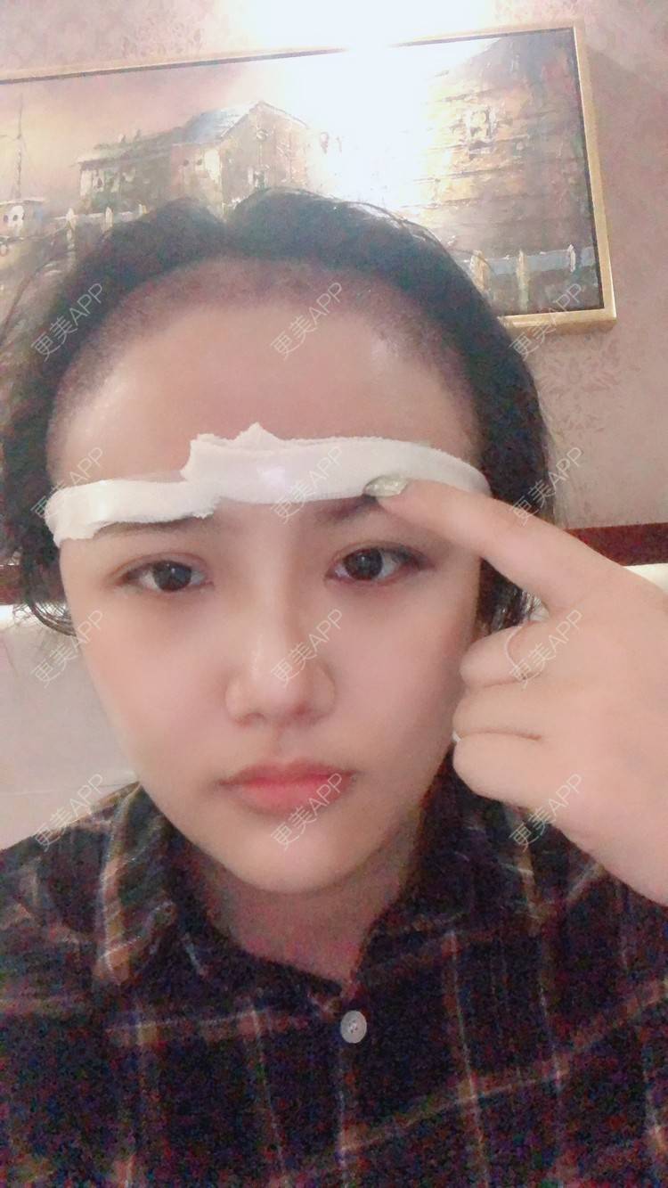 更美 - 奥多Ke。的植发际线经验 | 植发际线 | 南昌