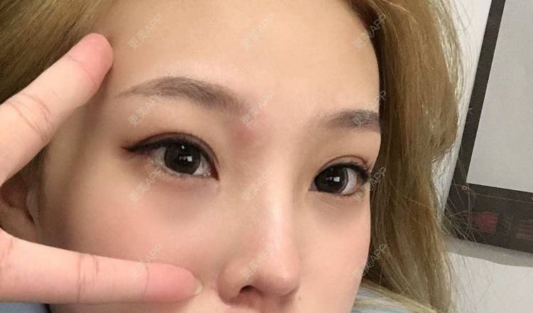 更美 - 二闪亮晶晶的全切双眼皮经验 | 广州 | 全切双眼皮